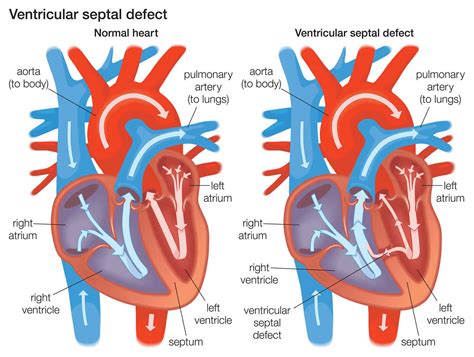 septum ventricular